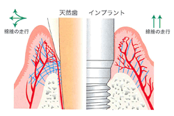 アタッチメントロスと歯周ポケットの深さ